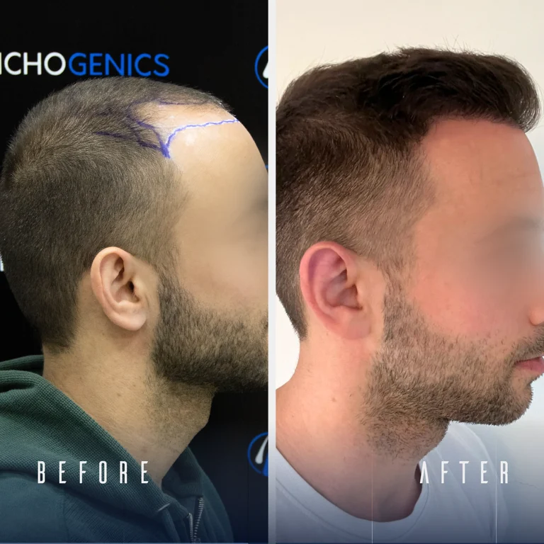 Trichogenics Patient