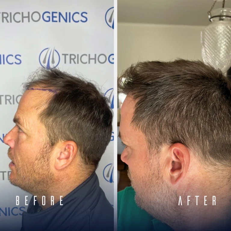 Trichogenics Patient