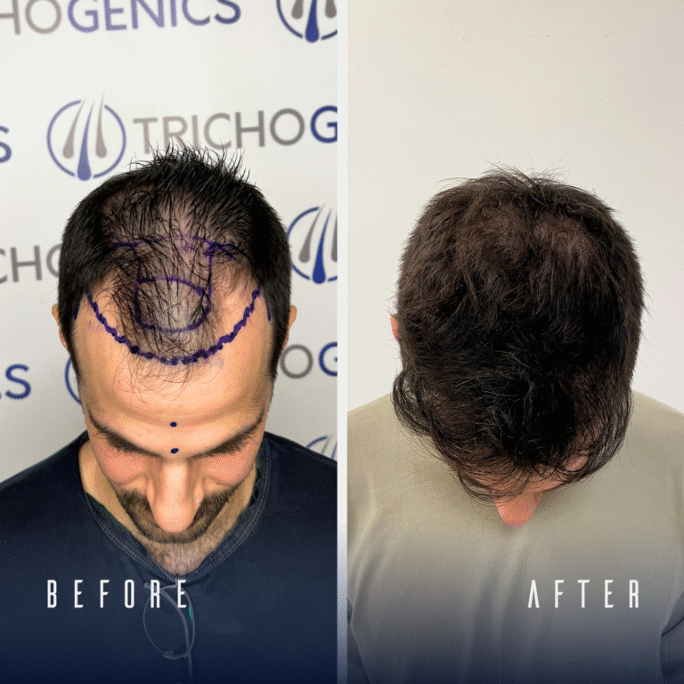 For more Before and Afters Visit our Hair Transplant Results Gallery