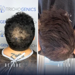 For more Before and Afters Visit our Hair Transplant Results Gallery