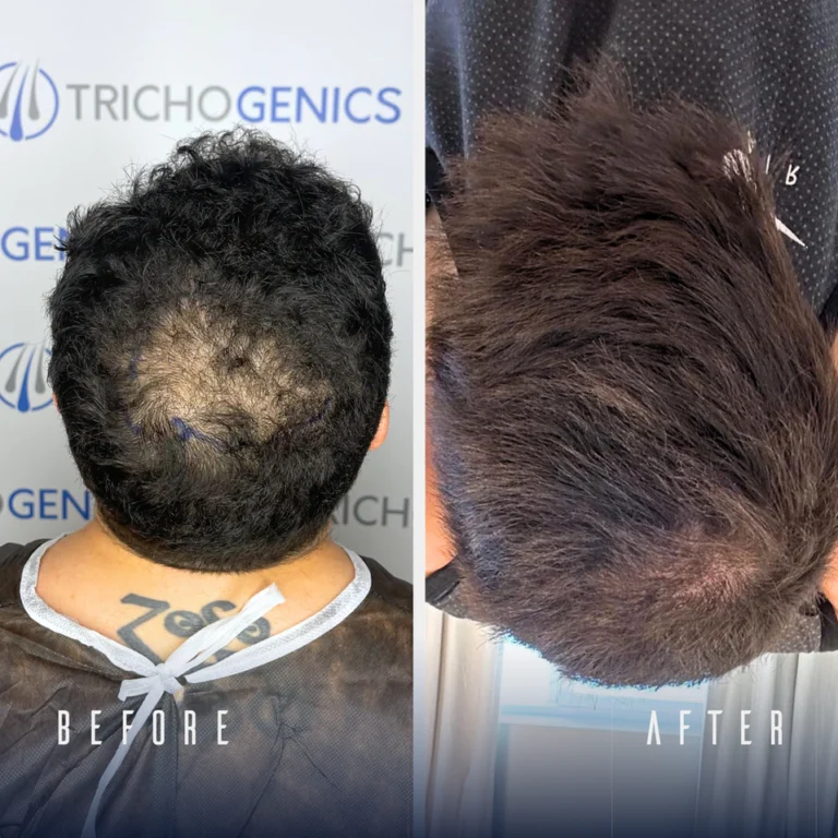 For more Before and Afters Visit our Hair Transplant Results Gallery