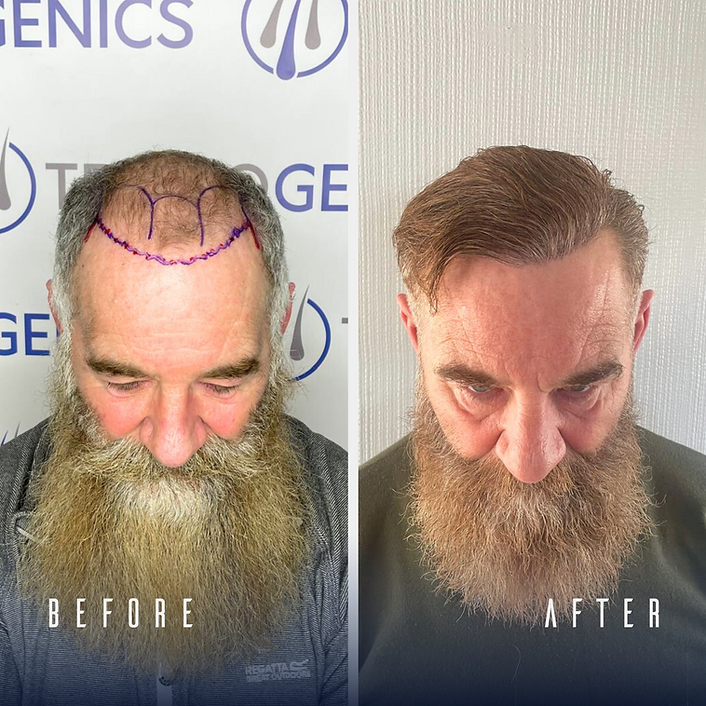 For more Before and Afters Visit our Hair Transplant Results Gallery