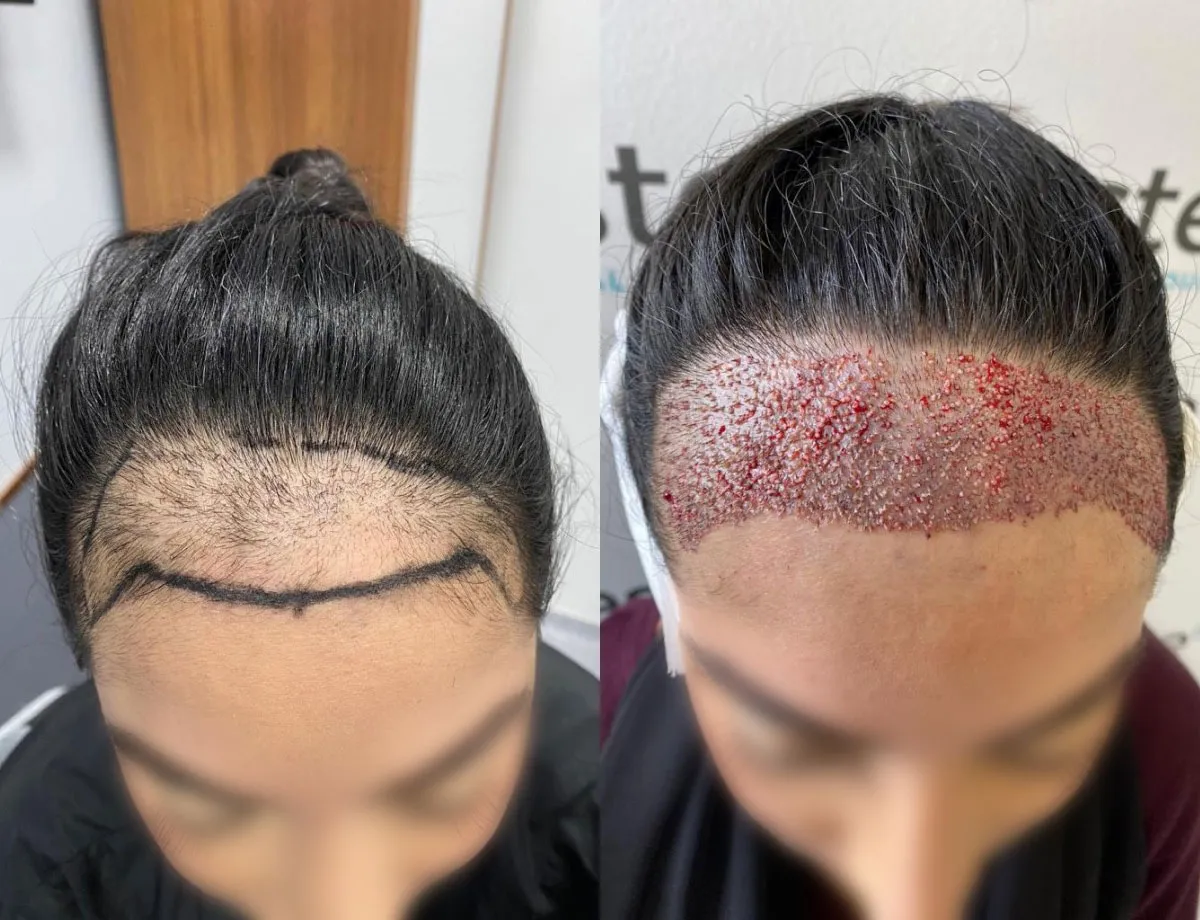 hairline transplant without shaving