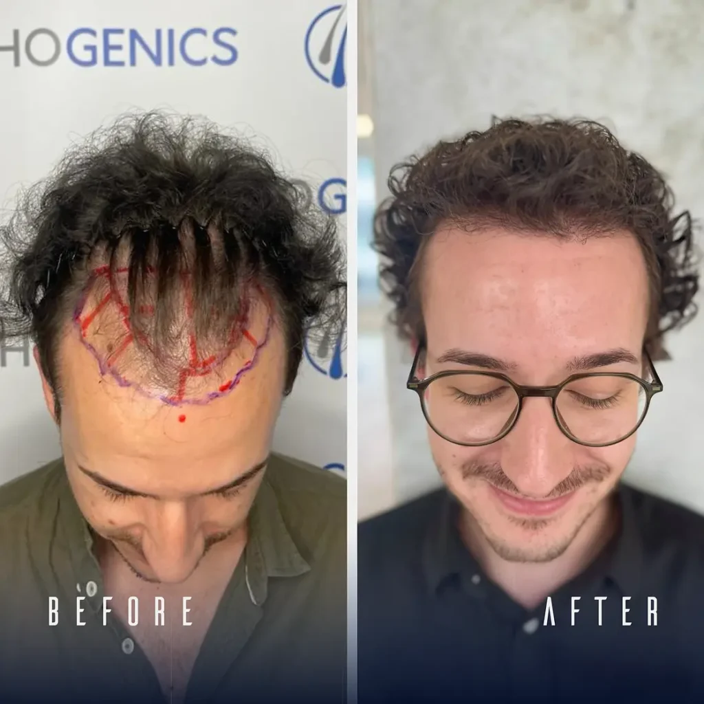 Hair Transplant 4 Months After: Growth and Results