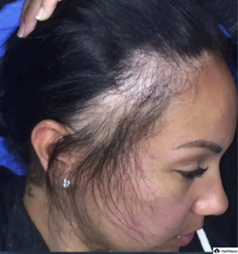 Traction Alopecia Hair Transplant in Greece & Israel