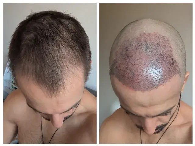 Ugly Duckling Phase Hair Transplant: Stages and Recovery