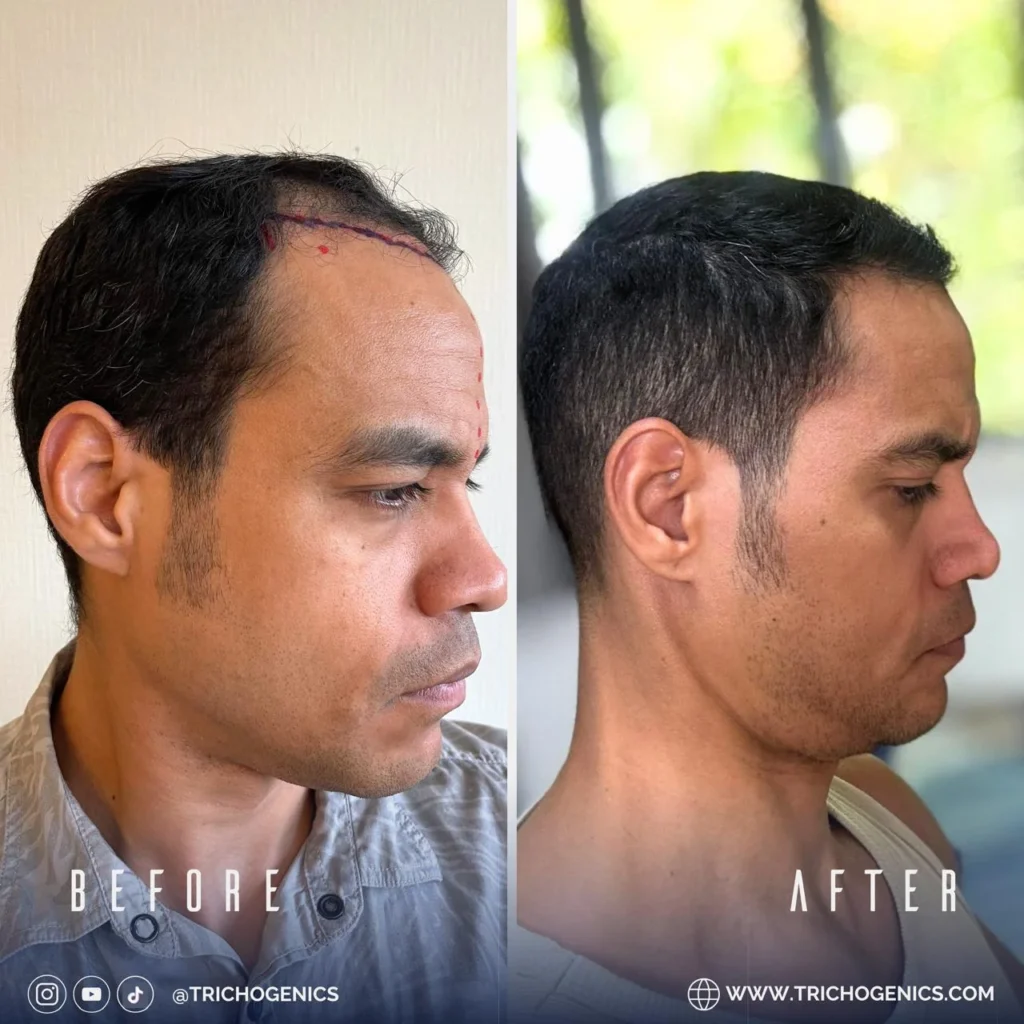 Hair Transplant Phases: Recovery and Growth Timeline