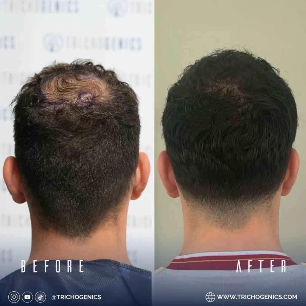 Hair Transplant Video: Real Surgery Explained