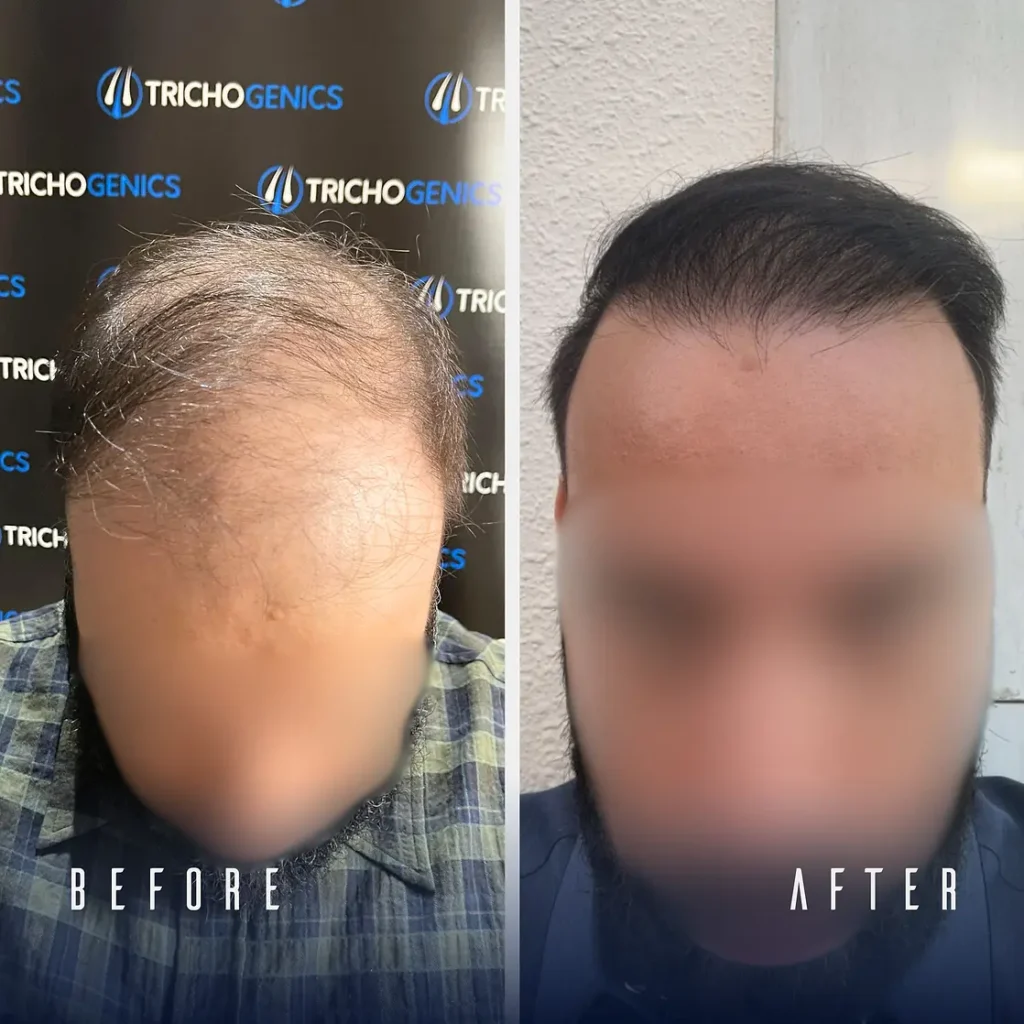 קרחת בקדמת הראש – מדריך מפורט למציאת הפתרון המדויק