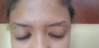 קרחת בגבה: סיבות רפואיות, אבחון מדויק ואפשרויות טיפול מבוססות