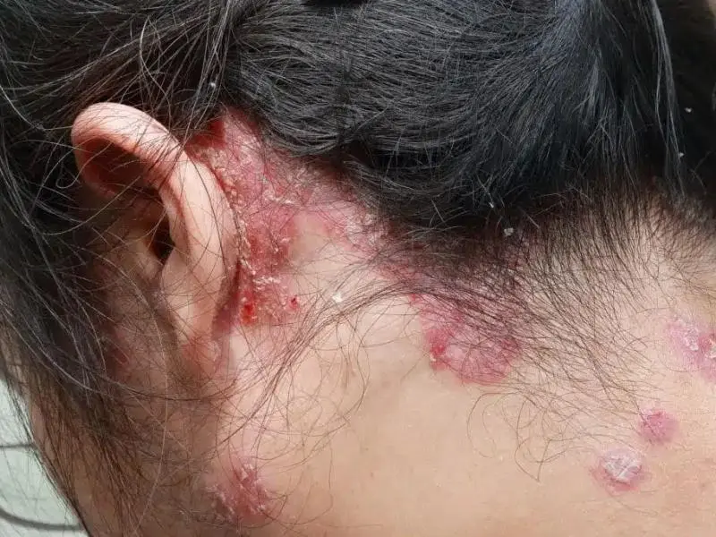 Can Psoriasis Cause Hair Loss? Symptoms and Causes