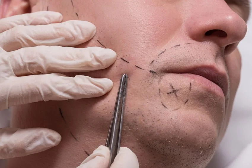 Facial Hair Transplant Surgery: Procedure Overview