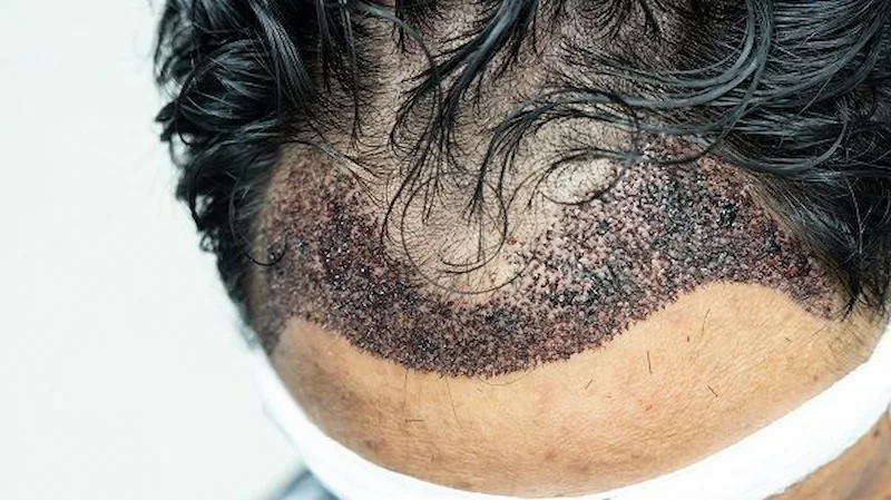 Hair Transplant Infection: Symptoms, Causes, And Treatment