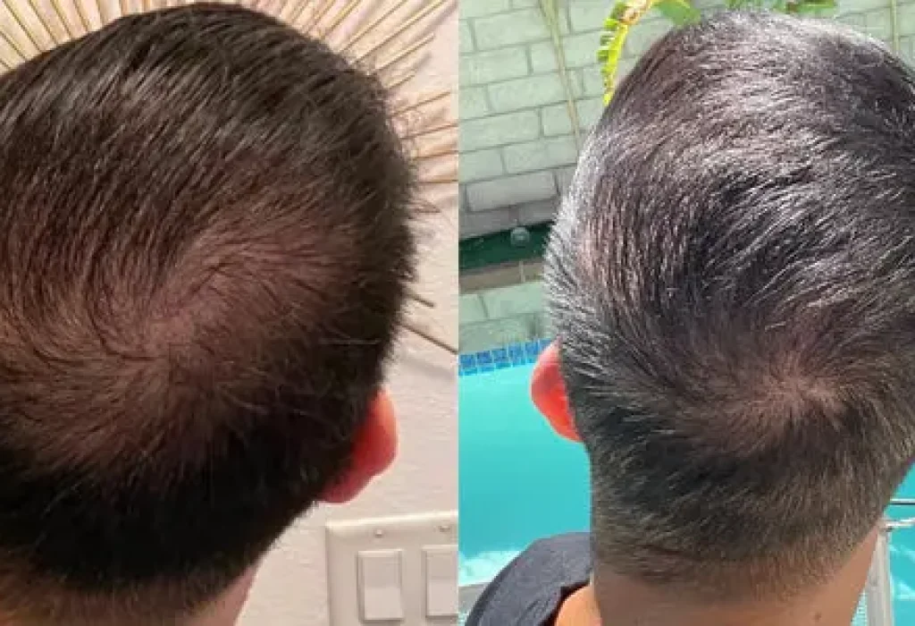 1-year-dutasteride-results-4