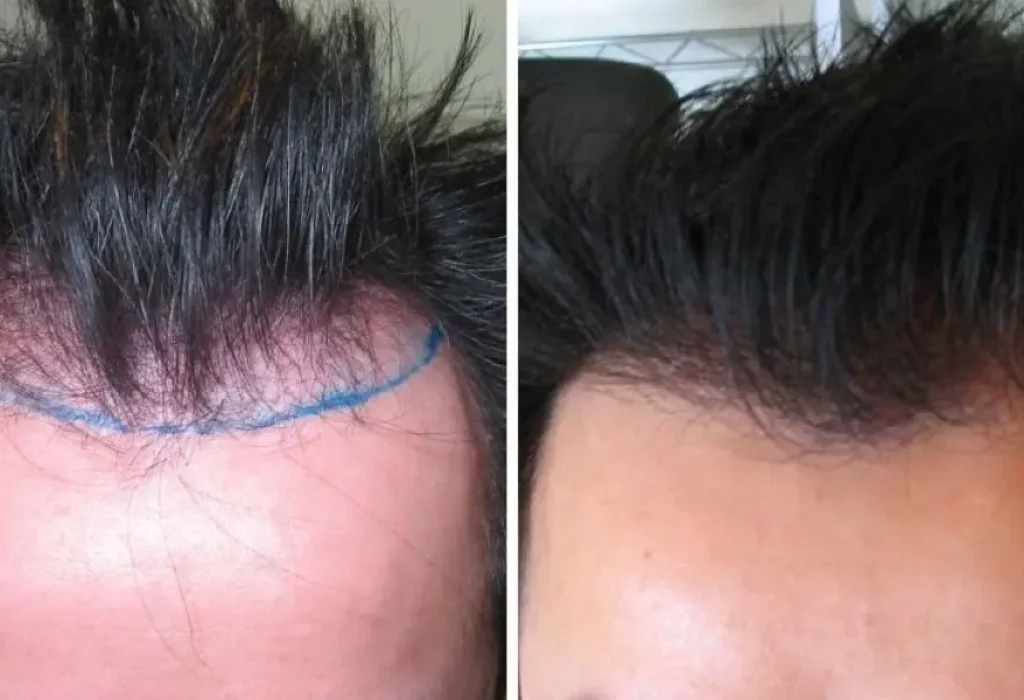 1000-grafts-hair-transplant