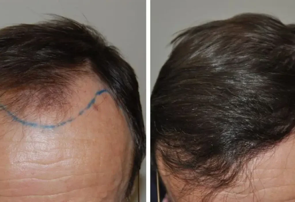 1500-grafts-hair-transplant
