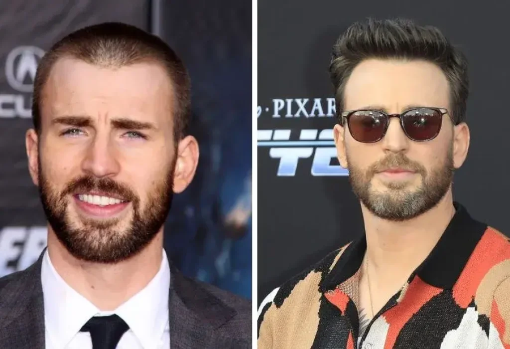 Chris-Evans-hair-transplant