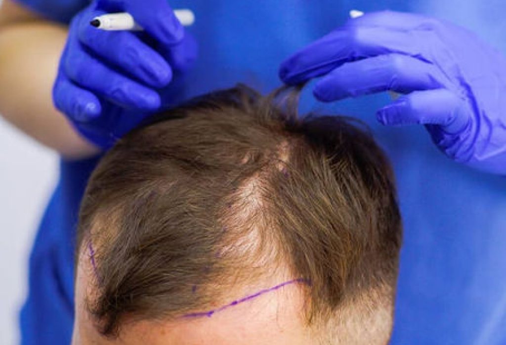 Crown-Hair-Transplant