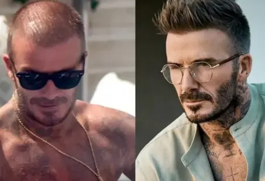 David-Beckham-Hair-Transplant,-What-We-Know