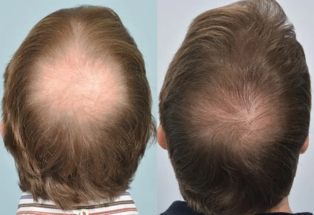 Hair-Transplant-in-Israel-Tel-HaShomer