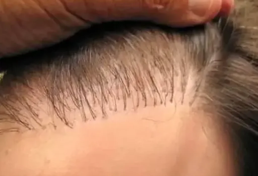 Hair-Transplants-in-Turkey-Safe