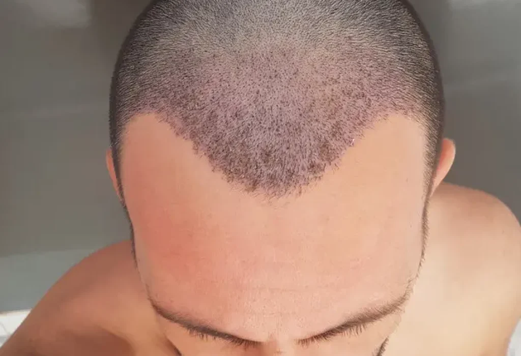 Hair-transplant-after-one-month