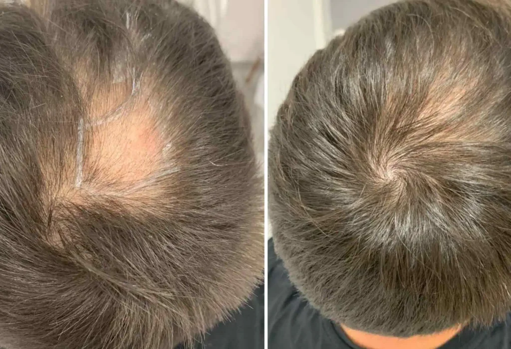 Hair-transplant-on-a-scar