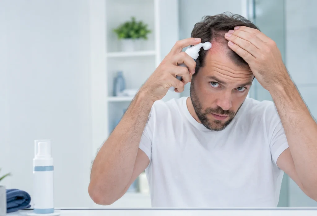 Minoxidil revision foam