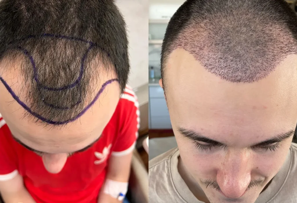 Ra-ama-hair-transplant