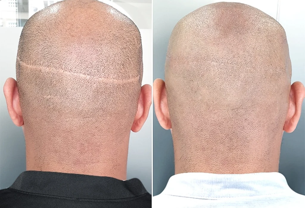 Scarless-hair-transplant