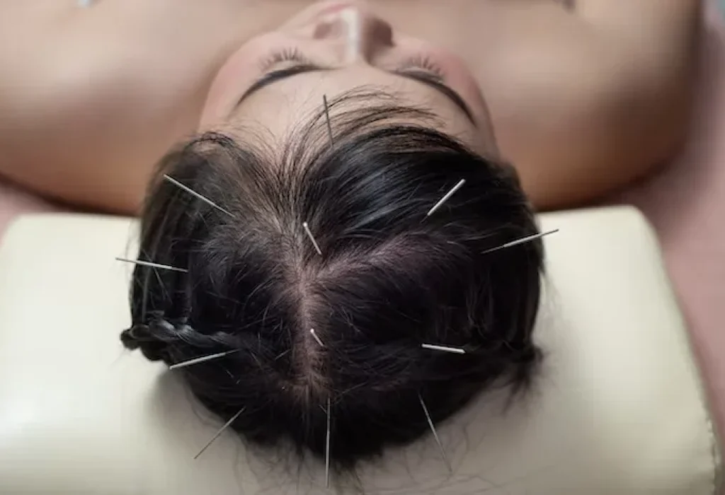 acupuncture-and-hair-loss