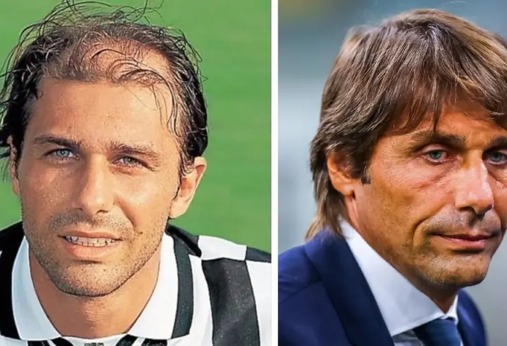 antonio-conte-hair-transplant-1
