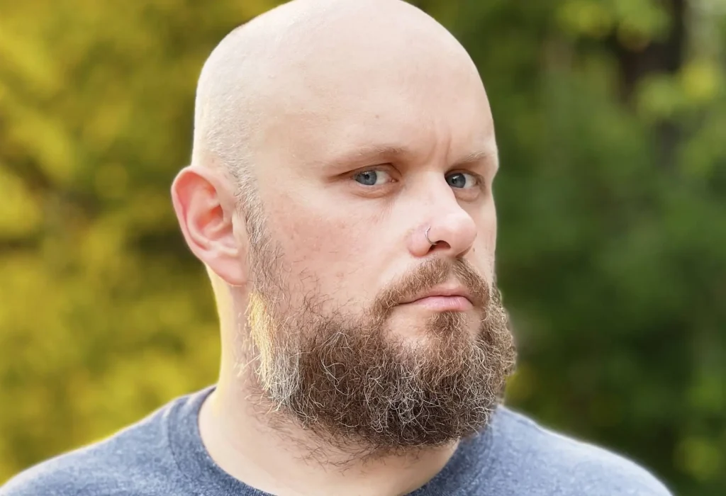 beard-hair-for-hair-transplant-1