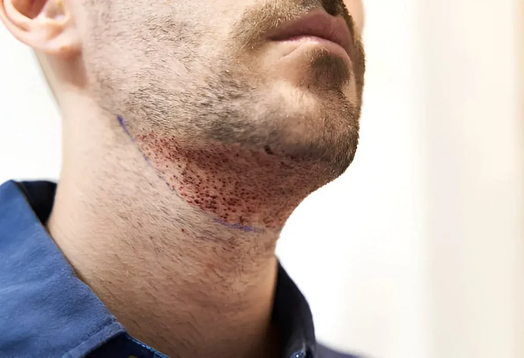 beard-hair-for-hair-transplant