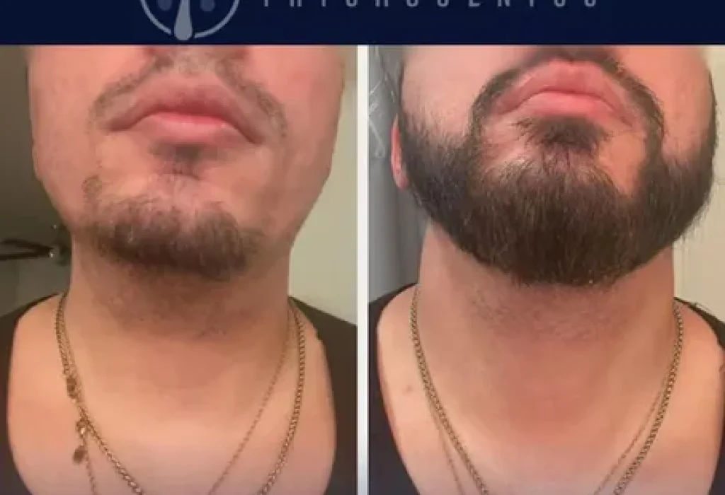 beard-hair