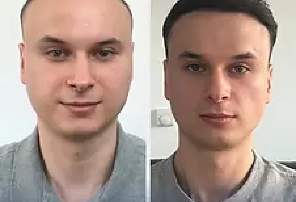 before after