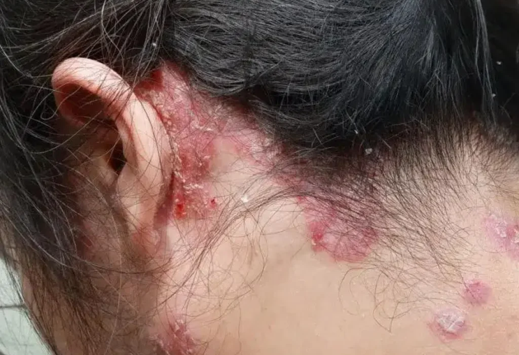 can-psoriasis-cause-hair-loss