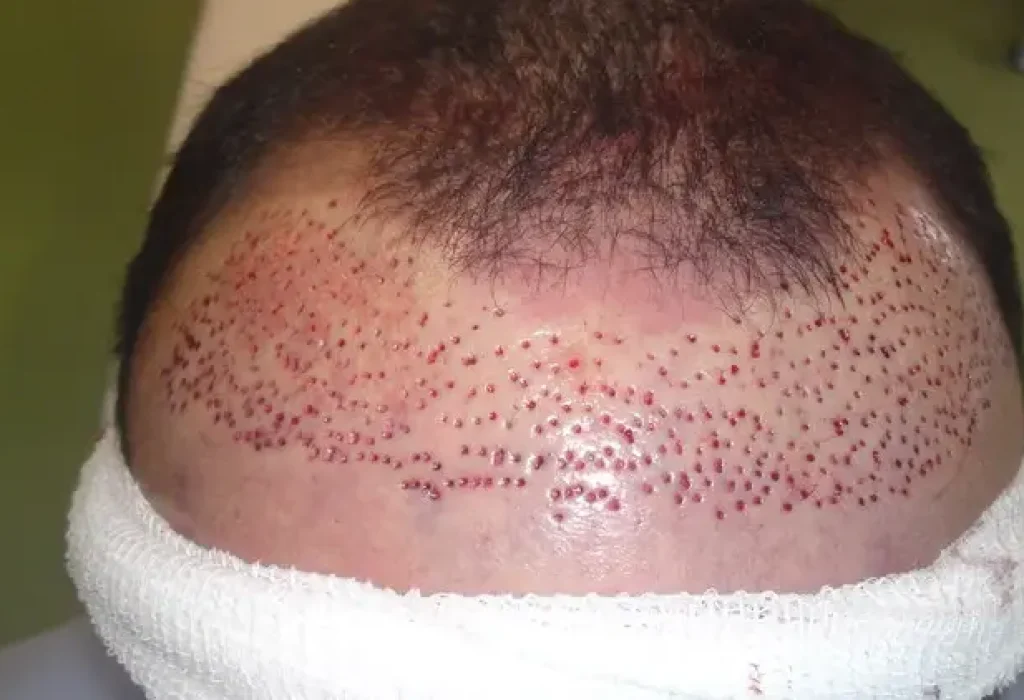 celebrity-hair-transplant-gone-wrong