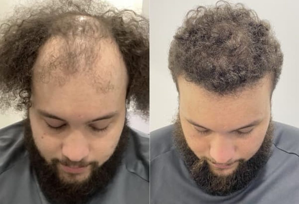 curly-hair- transplant