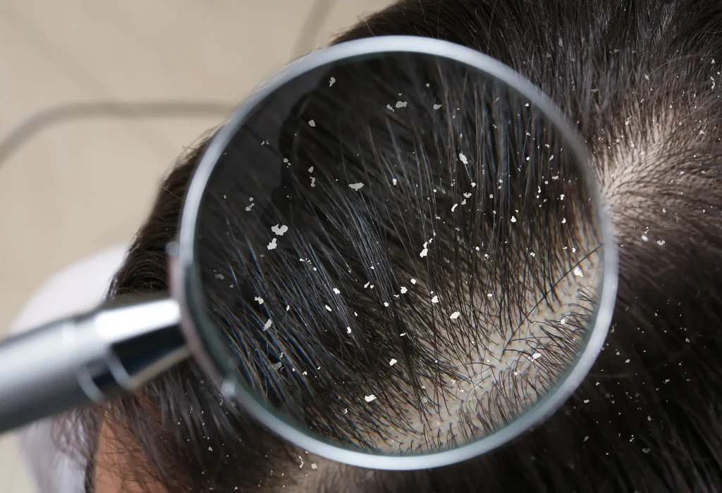 does-dandruff-causes-hair-loss