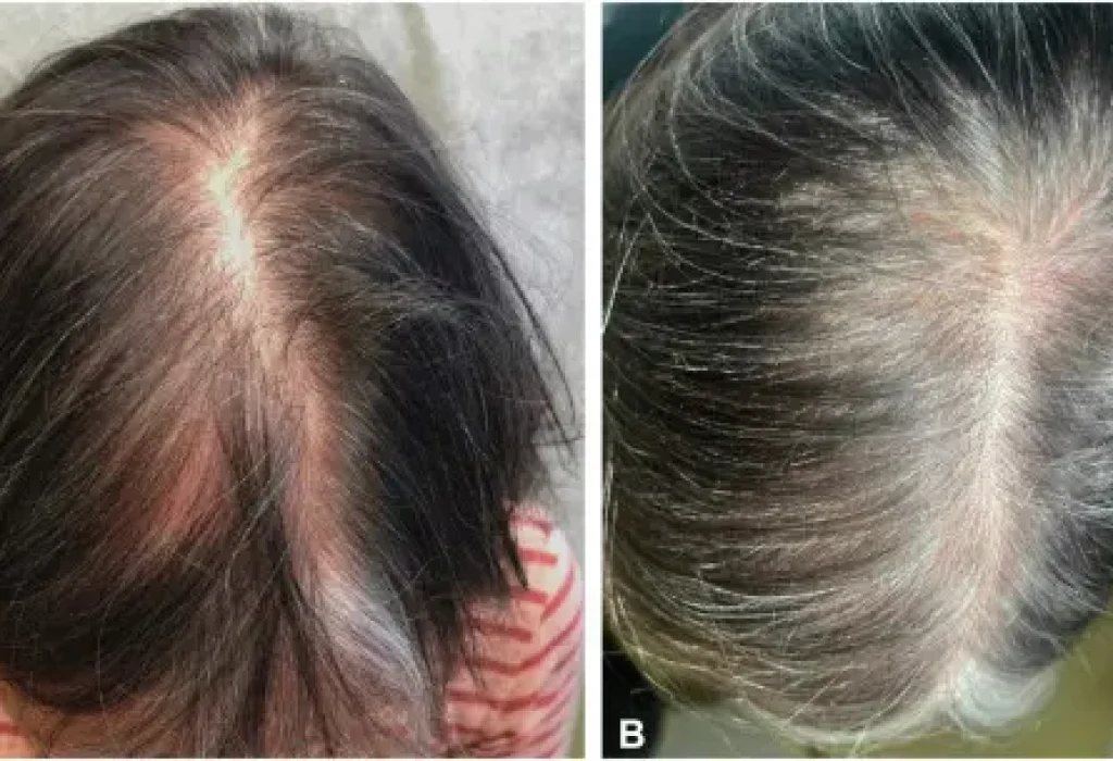 does-estrogen-cause-hair-loss-1