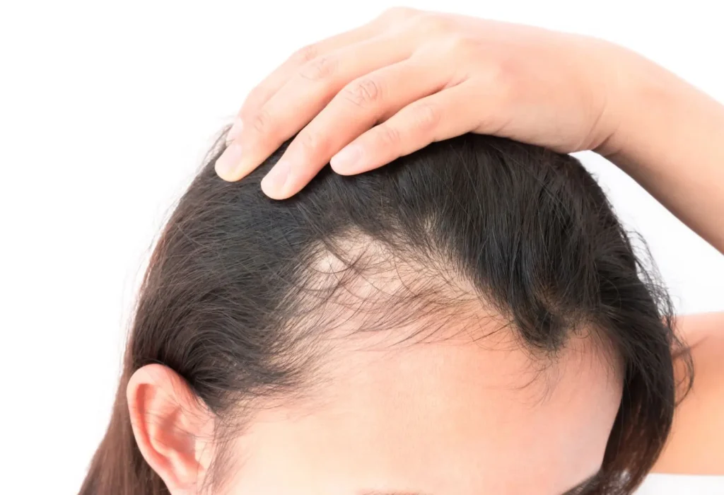 does-estrogen-cause-hair-loss