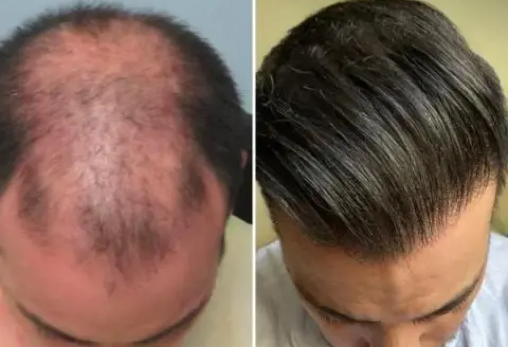 does hair grow back after tirzepatide Does Transplanted Hair Grow and Last Permanently?