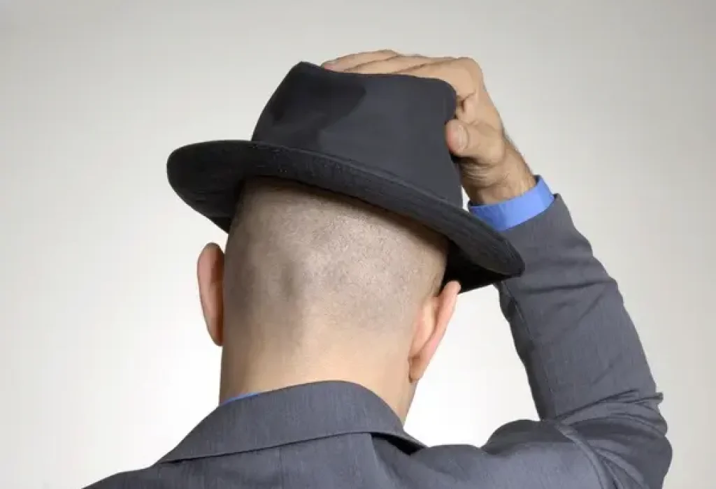 does-wearing-a-hat-causes-hair-loss