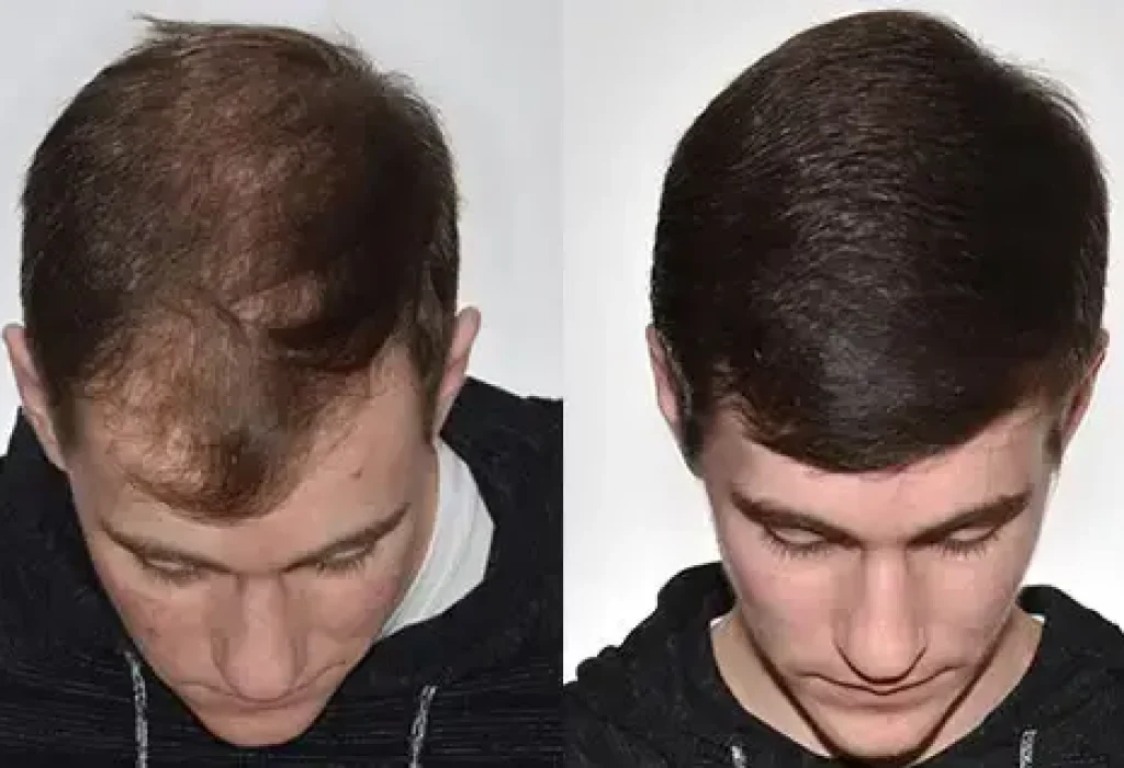 dtc-hair-transplant-reviews-1