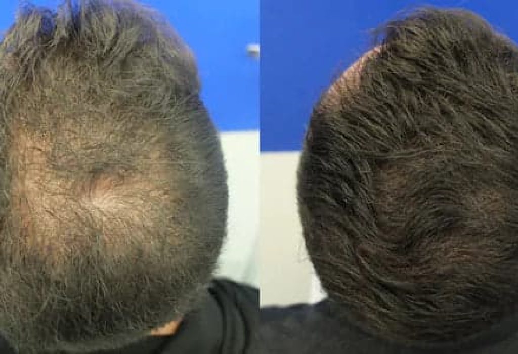 dutasteride-before-and-after