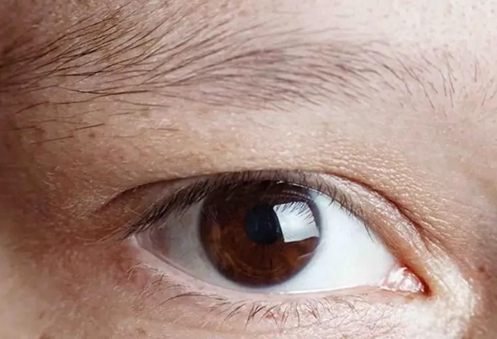 eyebrow-hairloss
