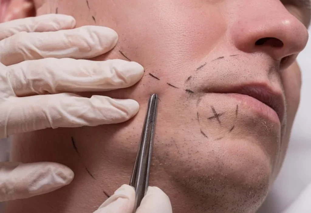facial-hair-transplant-surgery