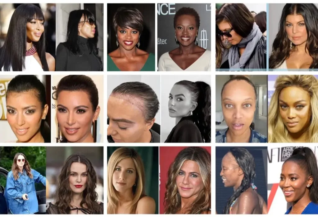 female-celebrity-hair-transplant-15