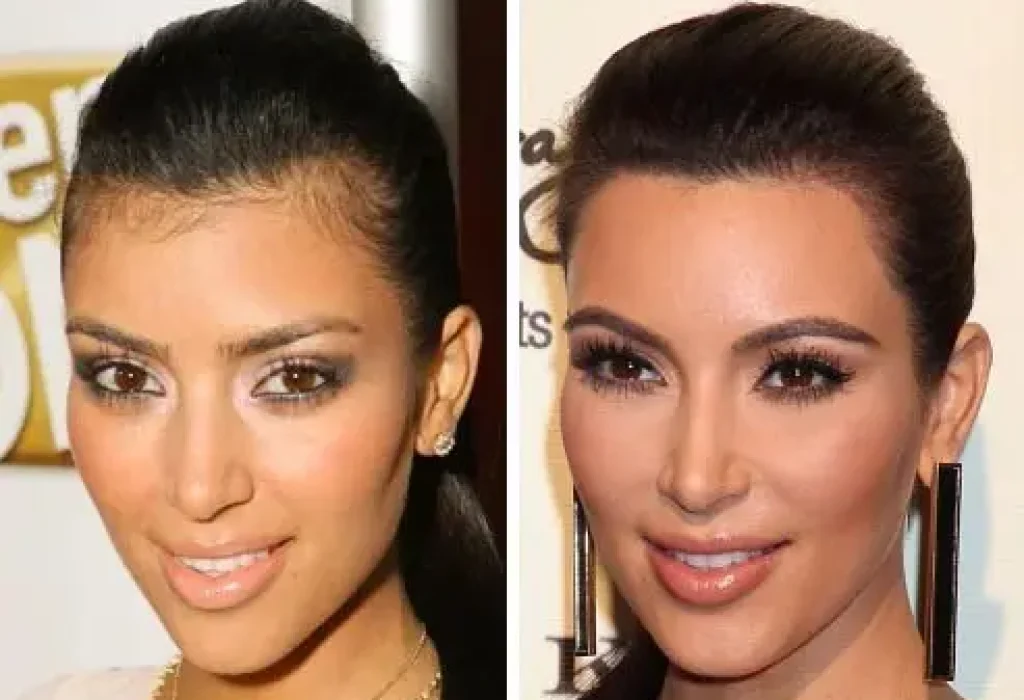 female-celebrity-hair-transplant-6